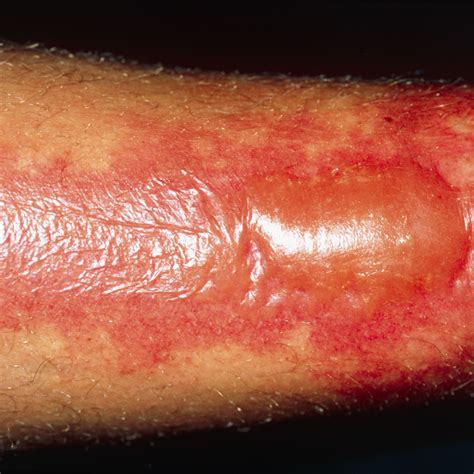 Signs of these burns include redness, discoloration, and pain at the contact site. . Rug burn pictures
